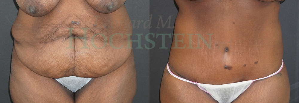 Tummy Tuck Patient
