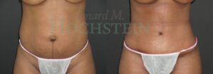 Tummy Tuck Patient