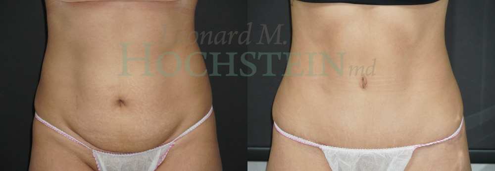 Tummy Tuck Patient