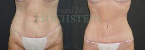 Tummy Tuck Patient
