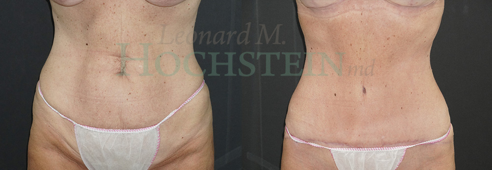 Tummy Tuck Patient