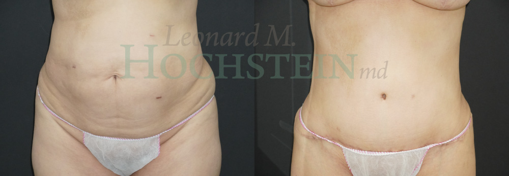 Tummy Tuck Patient