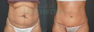 Tummy Tuck Patient 115