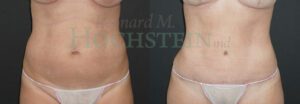 Tummy Tuck Patient 116