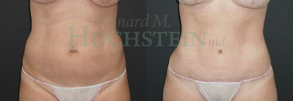 Tummy Tuck Patient