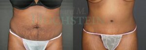 Tummy Tuck Patient 117