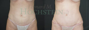 Tummy Tuck Patient 119