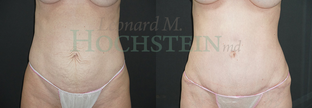 Tummy Tuck Patient