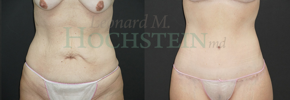 Tummy Tuck Patient