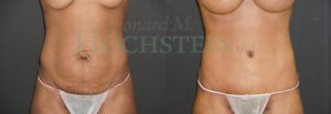 Tummy Tuck Patient 121
