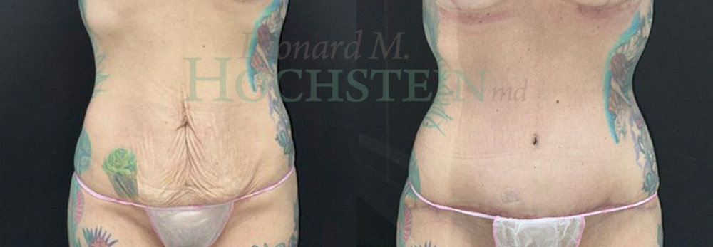 Tummy Tuck Patient