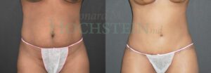 Tummy Tuck Patient 122