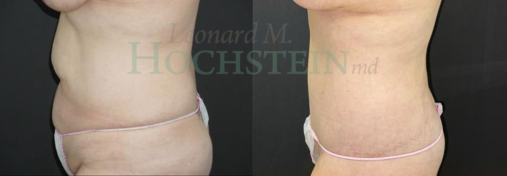 Tummy Tuck Patient