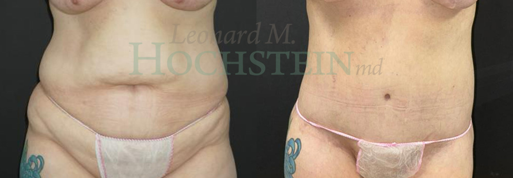 Tummy Tuck Patient
