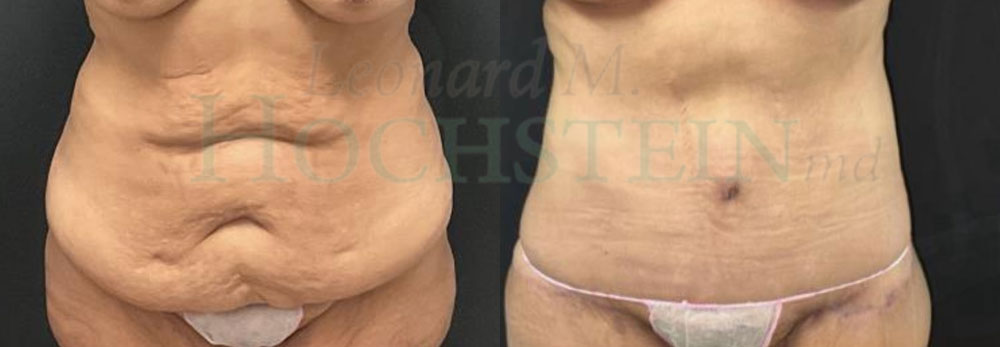 Tummy Tuck Patient