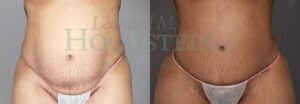 Tummy Tuck Patient 128