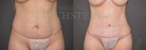 Tummy Tuck Patient 89
