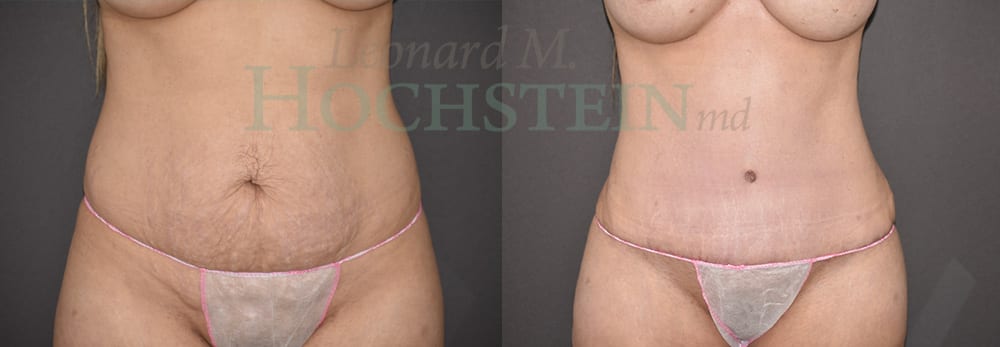 Tummy Tuck Patient