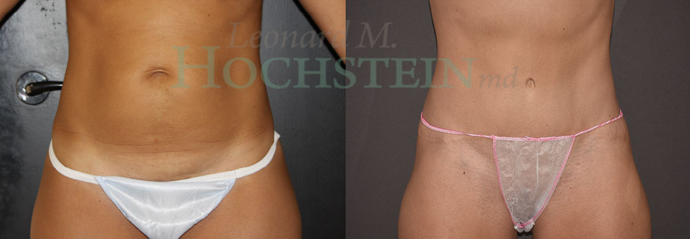 Tummy Tuck Patient