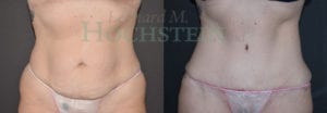Tummy Tuck Patient