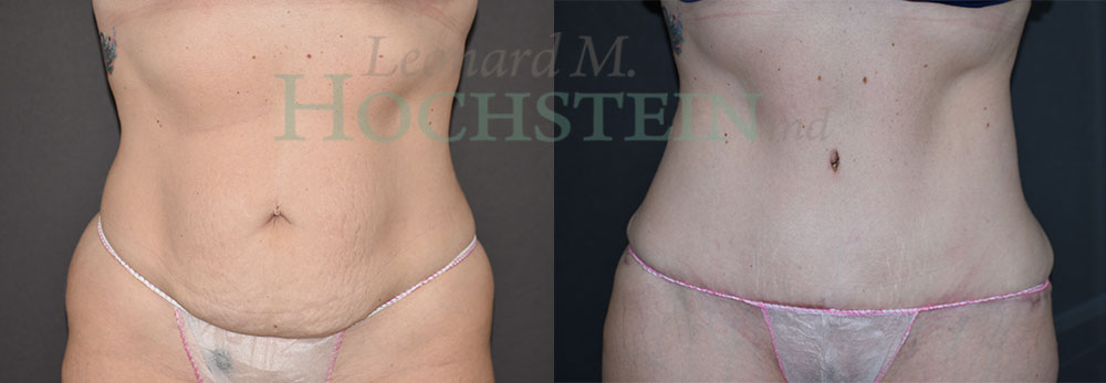 Tummy Tuck Patient