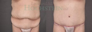 Tummy Tuck Patient 91