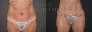 Tummy Tuck Patient