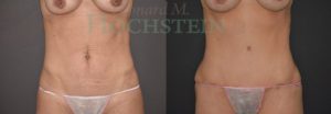 Tummy Tuck Patient 94