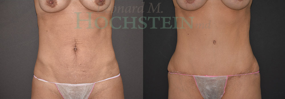 Tummy Tuck Patient