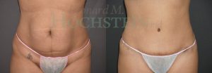 Tummy Tuck Patient