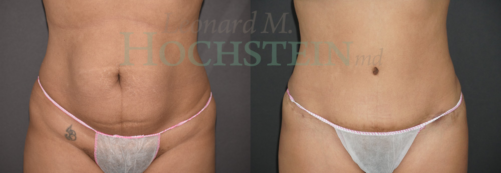 Tummy Tuck Patient