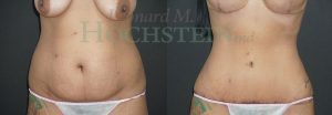 Tummy Tuck Patient