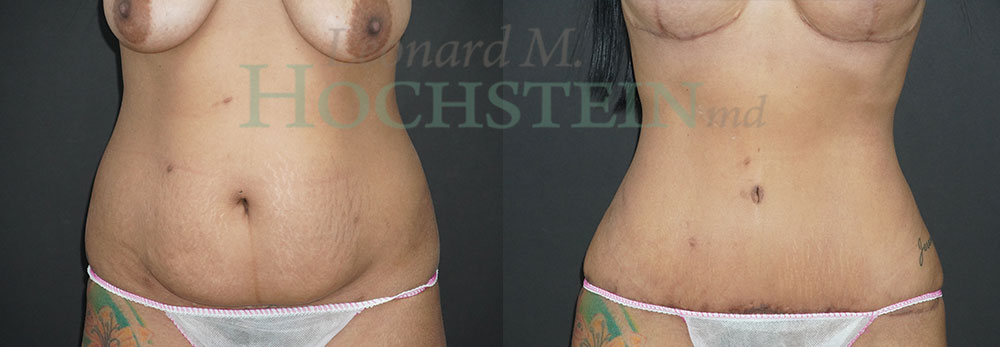 Tummy Tuck Patient