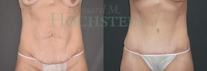 Tummy Tuck Patient