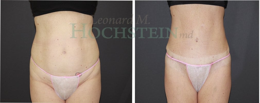 Tummy Tuck Patient