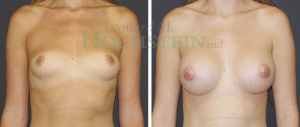 Breast Augmentation Patient