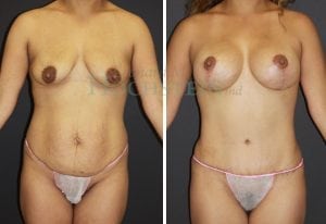 Mommy Makeover Patient