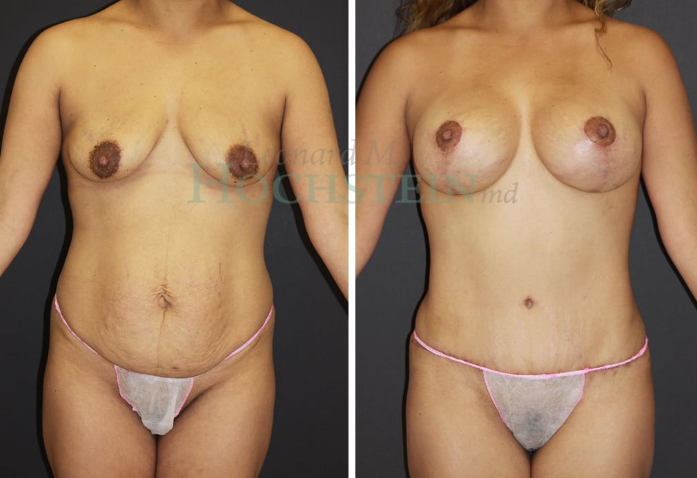 Mommy Makeover Patient