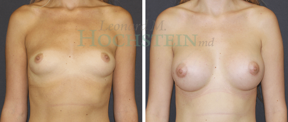 Breast Augmentation Patient