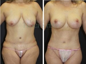 Mommy Makeover Patient